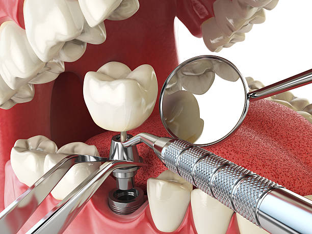 Best Broken or Cracked Tooth Emergency Dentist in Hurstbourne, KY